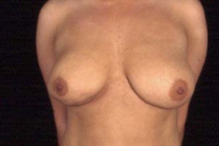 Breast Lift Before After Photos