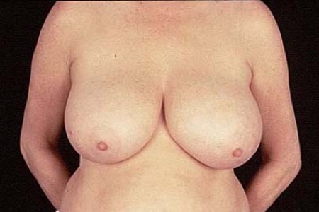 Liposuction Breast Reduction Before After Photos