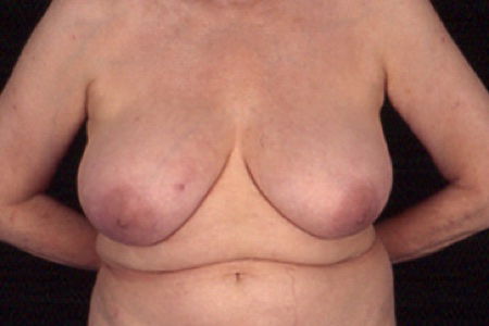 Liposuction Breast Reduction Before After Photos