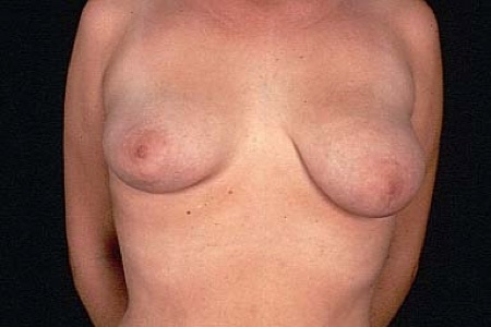 Lipoplasty Only Breast Reduction
