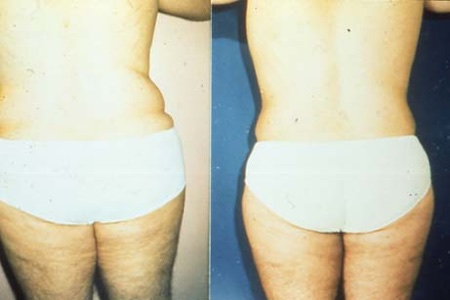 Before Liposuction