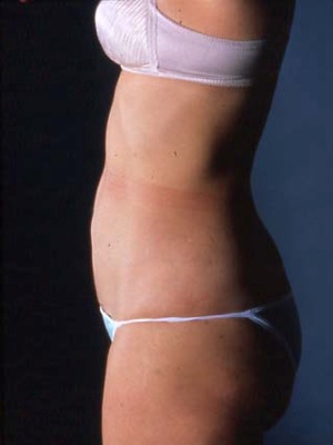 After Liposuction