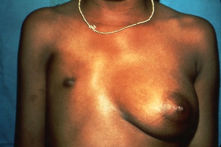 Breast Surgery Before After