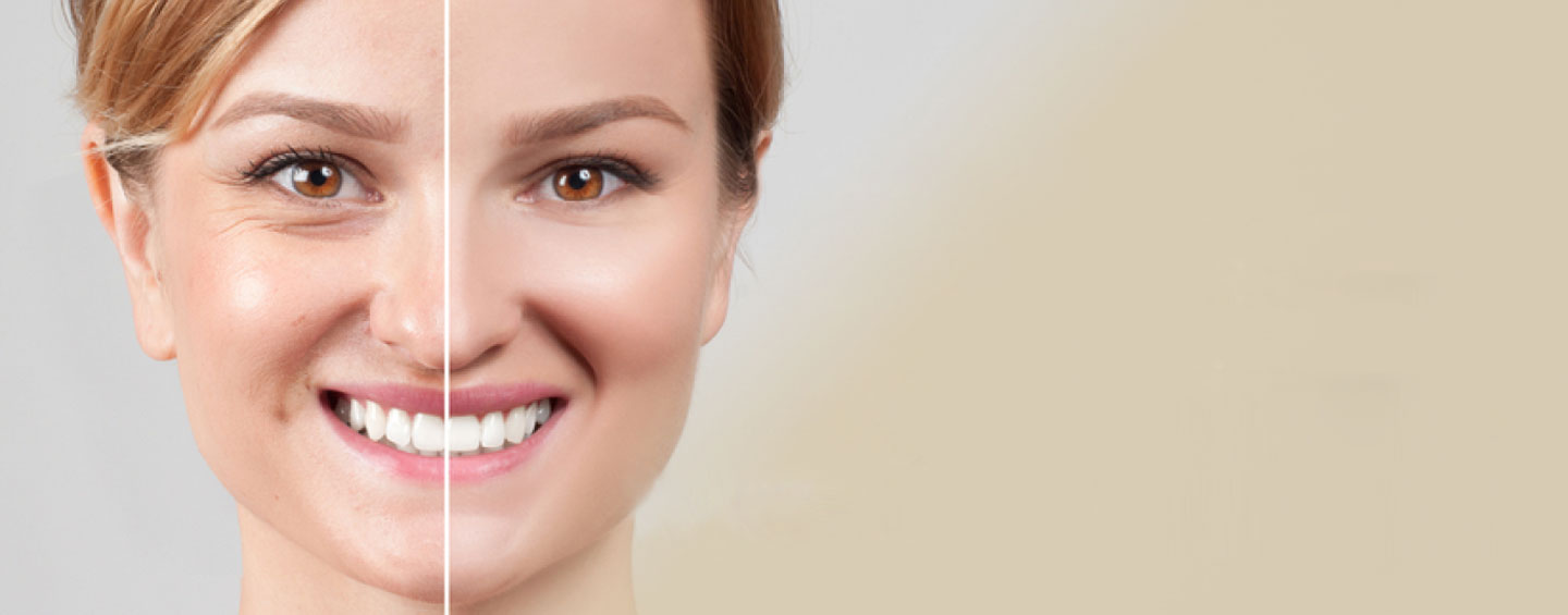 Endoscopic Forehead And Facelift