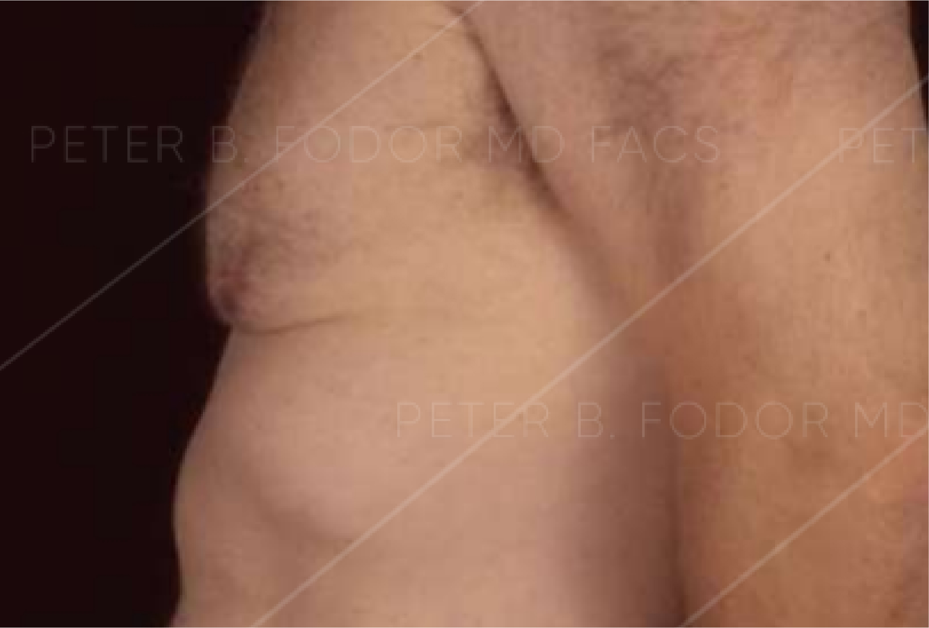Male Breast Reduction Before After Photos