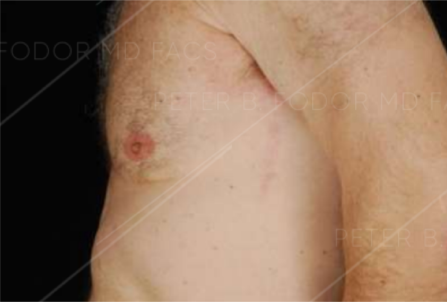 Male Breast Reduction Before After Photos