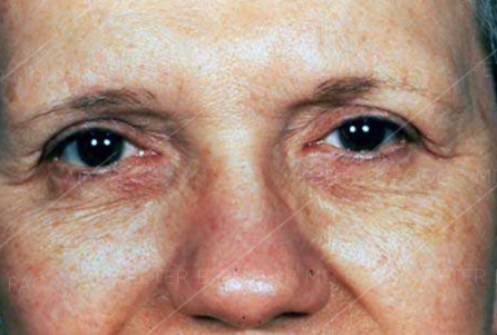 Eyelid Surgery Before After Photos