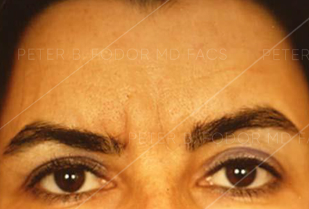 Forehead Lift Before After Photos