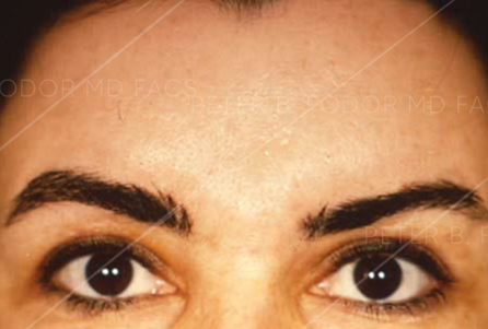 Forehead Lift Before After Photos