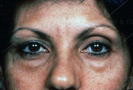 Eyelid Surgery Before After Photos