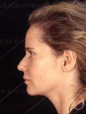 Before After Endoscopic Forehead Lift Photos