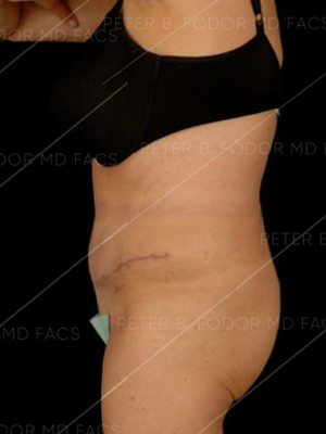 Tummy Tuck Before After Photos