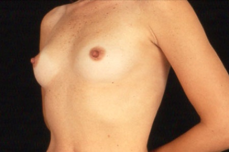 Breast-Augmentation-P-1A