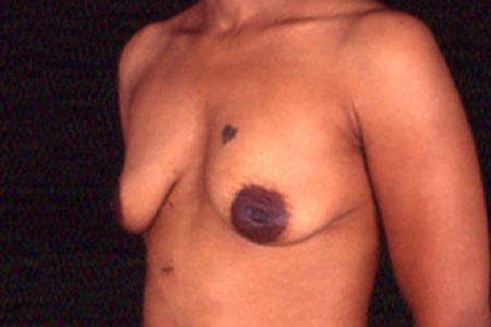 Breast Lift with Implants Before After