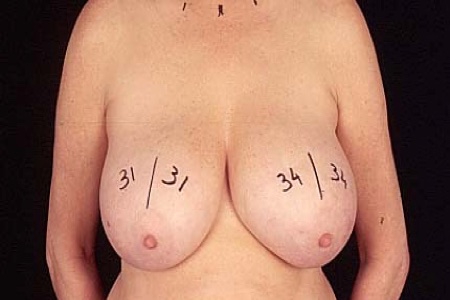 Breast Liposuction for Breast Reduction