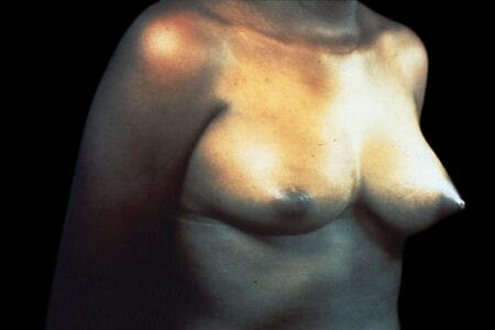 breast surgery before after