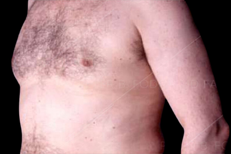 Male breast reduction surgery before after