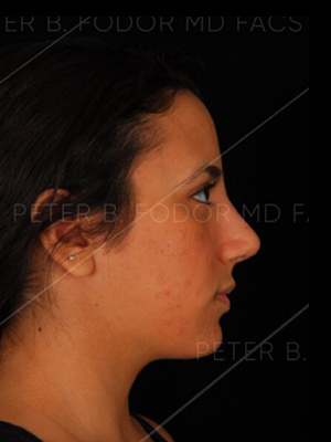 Rhinoplasty before after