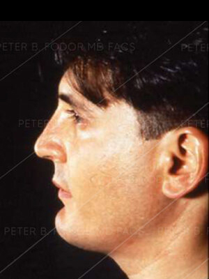 Rhinoplasty before after