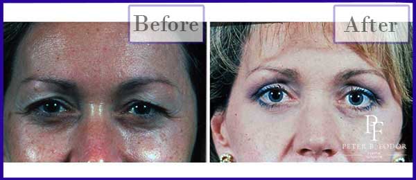 Eyelid Surgery Before and After Photos