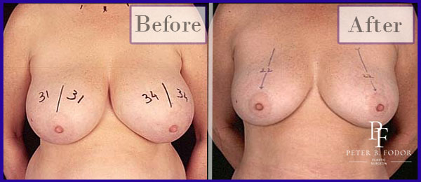 Scarless Breast Reduction Before and After Gallery by Los Angeles Plastic Surgeon Dr. Peter Fodor