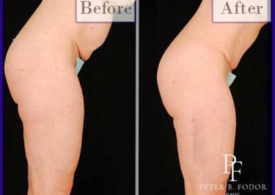 Tummy Tuck Before and After Photos with Natural Appearing Results
