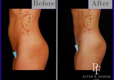 Tummy Tuck Before & After Photos