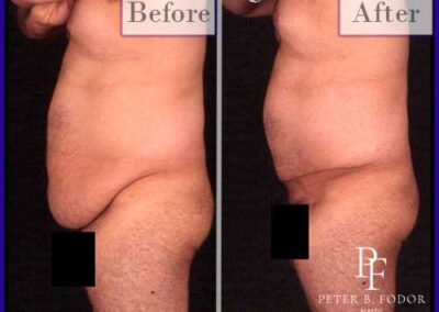 Male Tummy Tuck Before & After Photos