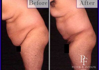 Male Tummy Tuck Before & After Photos