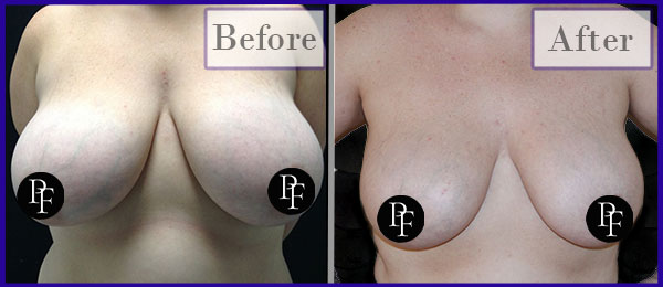 Scarless Breast Reduction Before and After