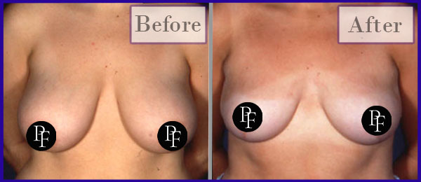 Breast Lift and reduction Before and After using minimum incisions.