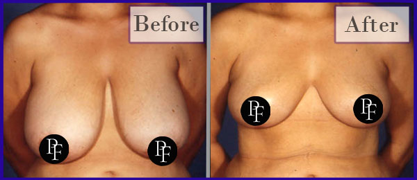 Breast Reduction Before and After photos show nice results with traditional breast reduction and lift scars.