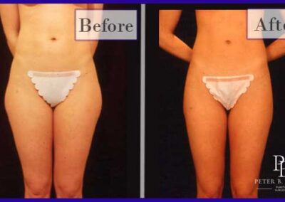 Liposuction Before and After