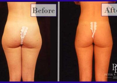 Liposuction Before and After