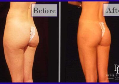 Liposuction Before and After