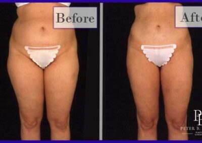 Liposuction Before and After