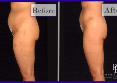 Liposuction Before and After