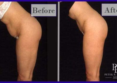 Liposuction Before and After