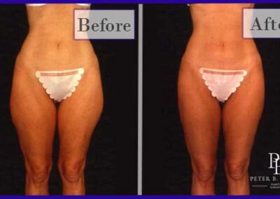 Liposuction Before and After