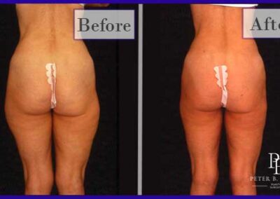 Liposuction Before and After