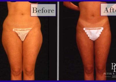 Liposuction Before and After