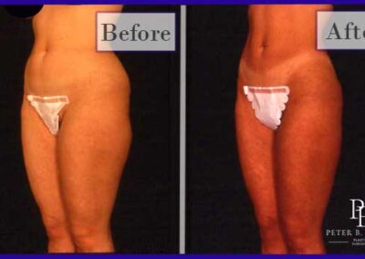 Liposuction Before and After