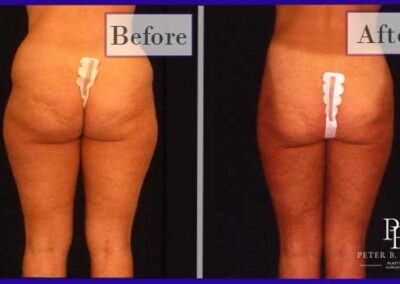 Liposuction Before and After