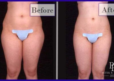 Liposuction Before and After