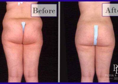 Liposuction Before and After