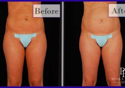 Liposuction Before and After