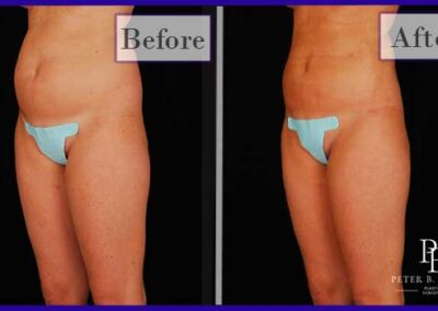 Liposuction Before and After