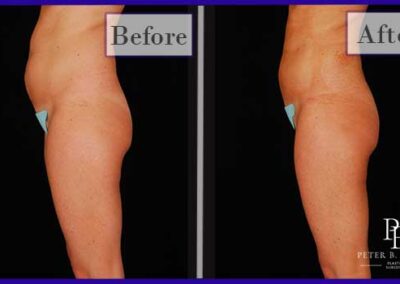 Liposuction Before and After