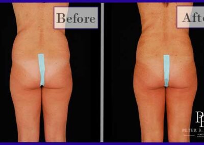 Liposuction Before and After