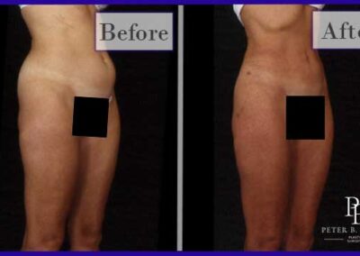 Liposuction Before and After